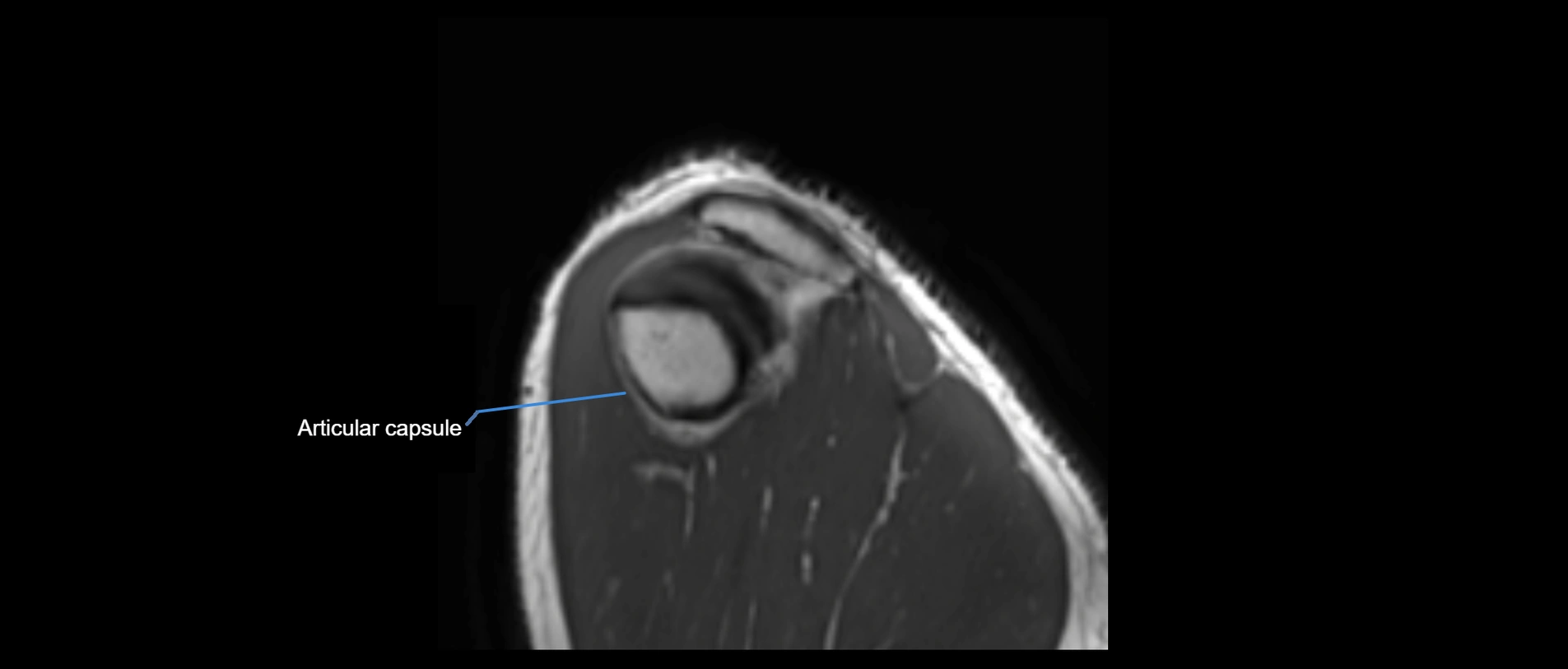shoulder ligaments sagittal  cross sectional anatomy 3T MRI AI enhanced radiology image -img-00001-00054.webp